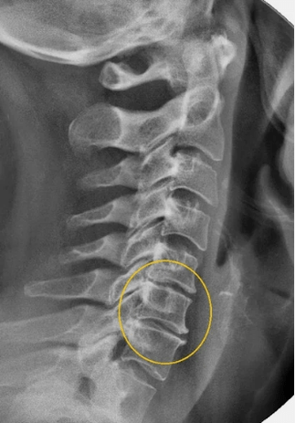 Dzemdes kakla mugurkaula osteohondroze uz x -ray